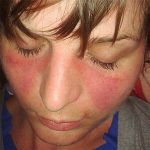 Lupusface600px Face with eyes closed showing Lupus Erythematosus on the skin of the cheeks, nose and chin.