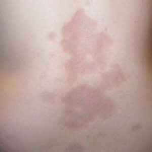Morphea600px Close up of a human's back with morphea