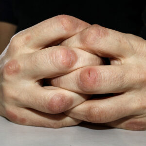 Psoriasis:,Close,View,Of,Hands,Affected,By,Psoriasis,On,Fingers, Hands folded together showing dermatomyositis on the knuckles and joints of both hands