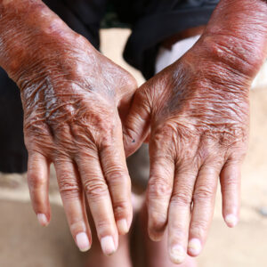 Skin,Disorder,,Pepper,Appearance,From,Scleroderma,,Autoimmune,Disease,Male,Hand Picture of hands with Systemic Scleroderma.