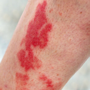 Leukocytoclastic,Vasculitis,,An,Inflammatory,Reaction,In,The,Blood,Vessels.,Aka Vasculitis