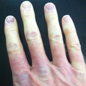 Raynaud Mixed Connective Tissue Disease - Raynaud's Syndrome.